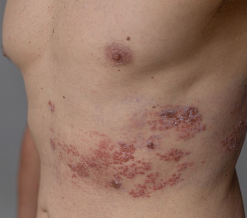 CASOS DE HERPES-ZÓSTER CRESCEM E AFETAM A SAÚDE BUCAL}