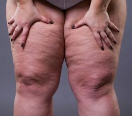 Lipedema: conheça doença confundida com obesidade que afeta mais de 11% das mulheres}