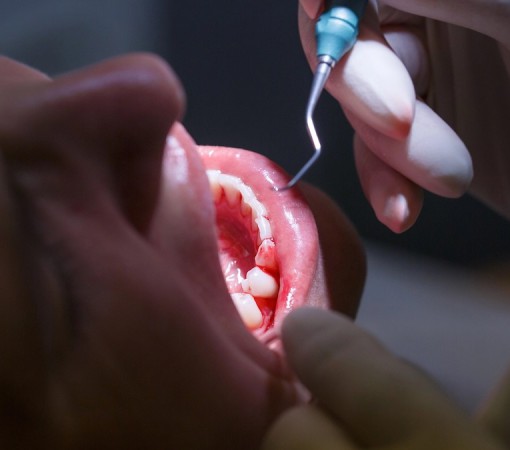 PERIODONTITE É SILENCIOSA E PODE AFETAR A SAÚDE ALÉM DOS DENTES}