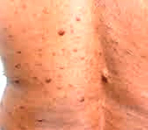 NEUROFIBROMATOSE TIPO 1: CONHEÇA A DOENÇA GENÉTICA QUE PODE CAUSAR MANCHAS NA PELE}