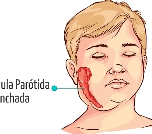 COMO RECONHECER OS SINTOMAS DA CAXUMBA}