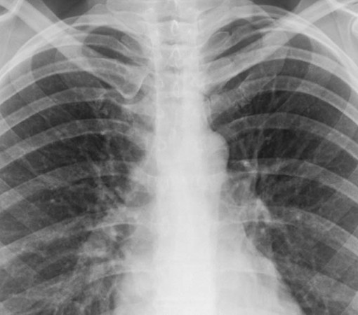 PNEUMONIA - CUIDADOS E RECOMENDAÇÕES}