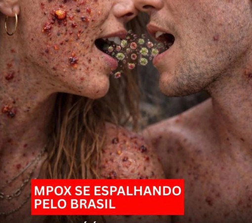 CENÁRIO ATUAL (2026): VÍRUS MPOX - ANTIGAMENTE CHAMADO DE VARÍOLA DOS MACACOS}