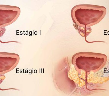 CÂNCER DE PRÓSTATA}