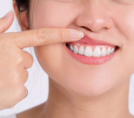 GENGIVOPLASTIA MELHORA A ESTÉTICA E FACILITA A HIGIENE BUCAL}