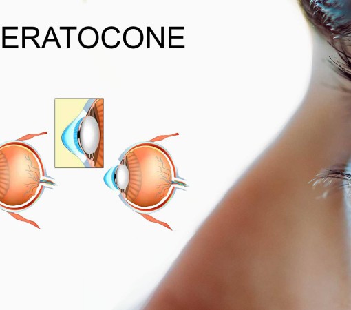 Ceratocone afeta milhões de pessoas em todo o mundo e no Brasil}