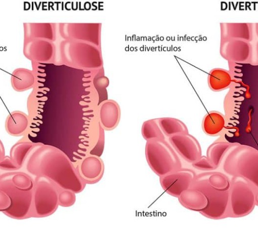 DIVERTICULITE E DIVERTICULOSE}