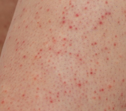 QUERATOSE PILAR}