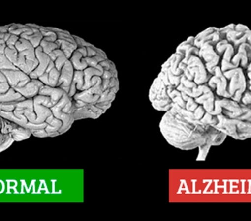 DOENÇA DE ALZHEIMER}