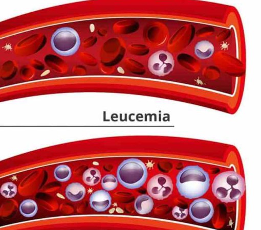 LEUCEMIA}