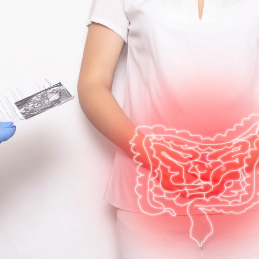 DIVERTICULITE E DIVERTICULOSE