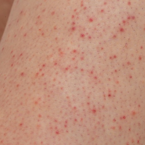 QUERATOSE PILAR
