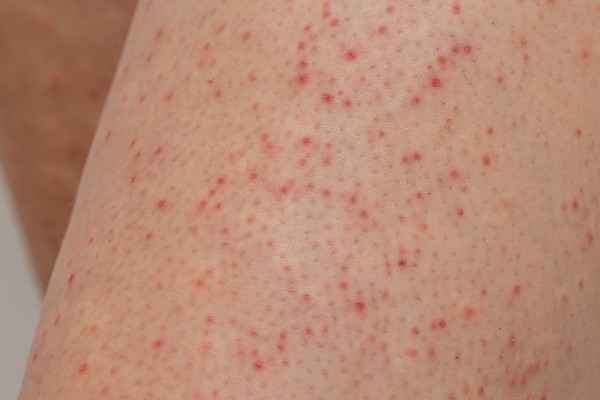 QUERATOSE PILAR}