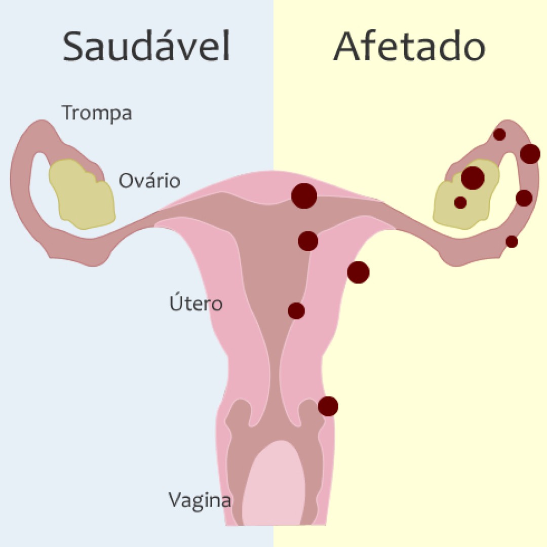 ENDOMETRIOSE