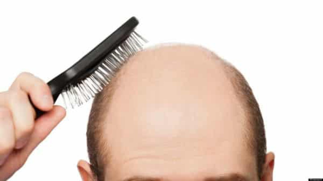 CALVÍCIE (ALOPECIA ANDROGENÉTICA)
