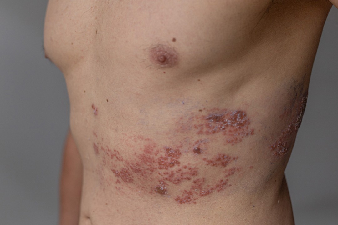 CASOS DE HERPES-ZÓSTER CRESCEM E AFETAM A SAÚDE BUCAL
