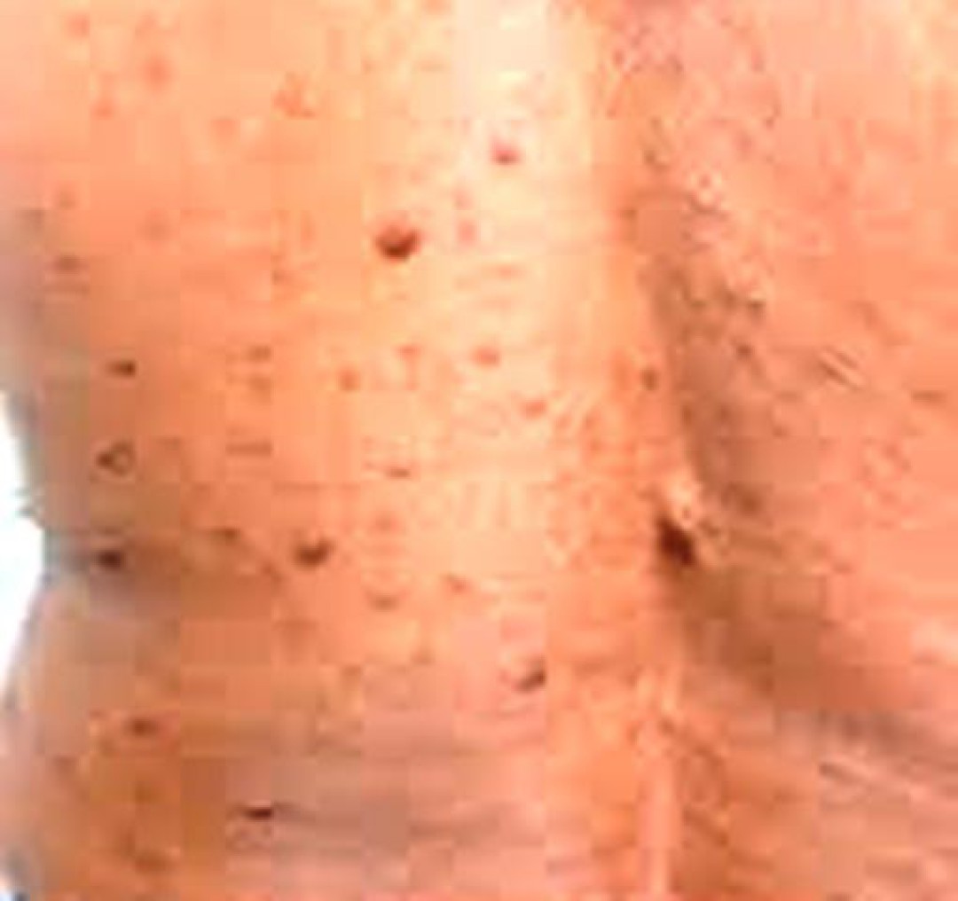 NEUROFIBROMATOSE TIPO 1: CONHEÇA A DOENÇA GENÉTICA QUE PODE CAUSAR MANCHAS NA PELE