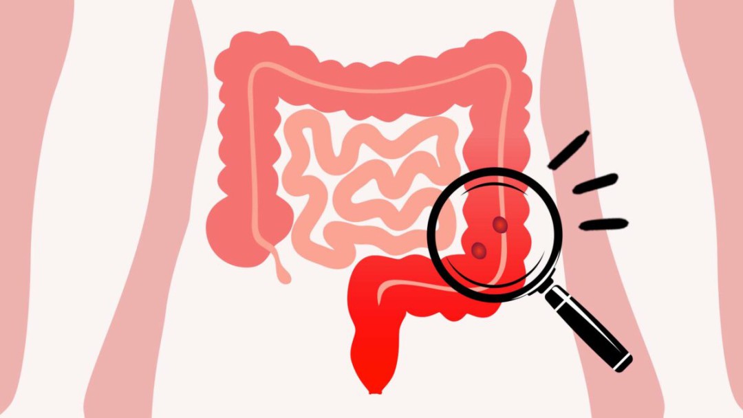 CÂNCER DE INTESTINO