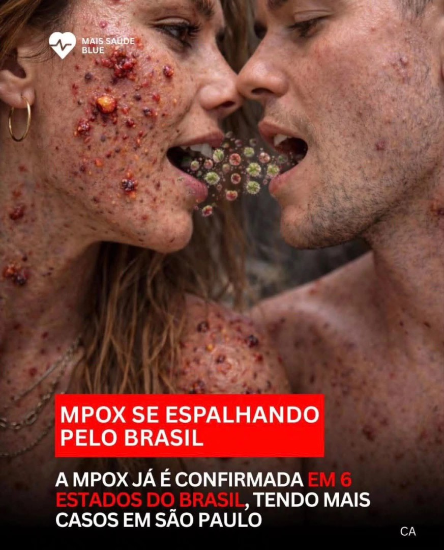CENÁRIO ATUAL (2026): VÍRUS MPOX - ANTIGAMENTE CHAMADO DE VARÍOLA DOS MACACOS