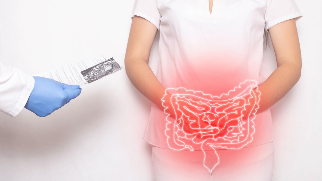 DIVERTICULITE E DIVERTICULOSE