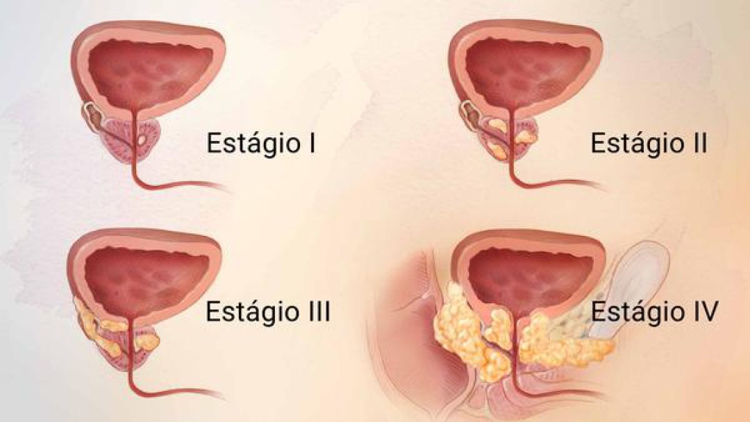 CÂNCER DE PRÓSTATA