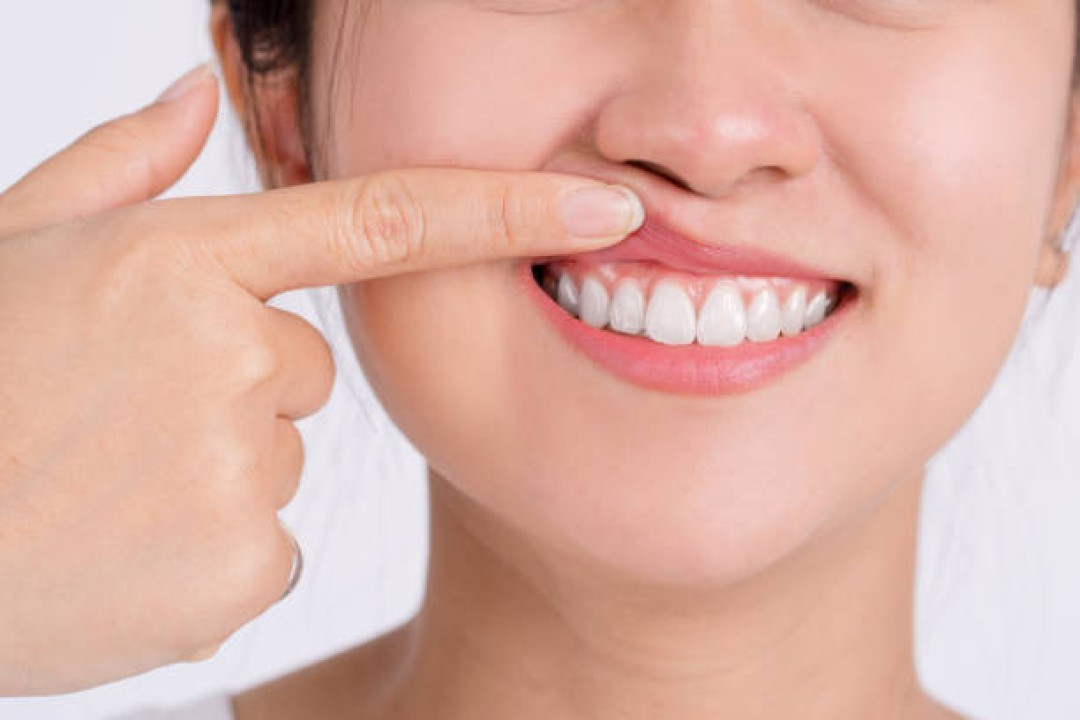 GENGIVOPLASTIA MELHORA A ESTÉTICA E FACILITA A HIGIENE BUCAL