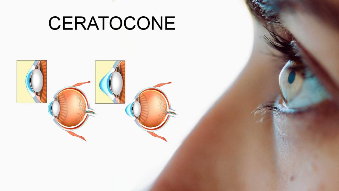 Ceratocone afeta milhões de pessoas em todo o mundo e no Brasil