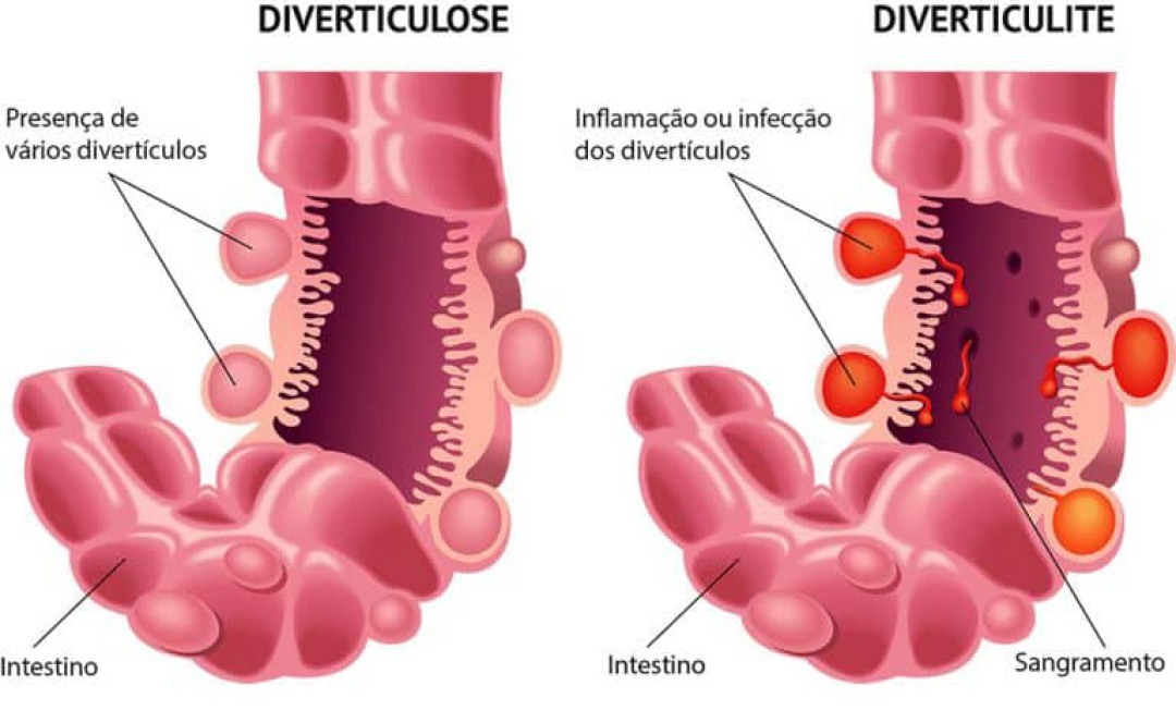 DIVERTICULITE E DIVERTICULOSE