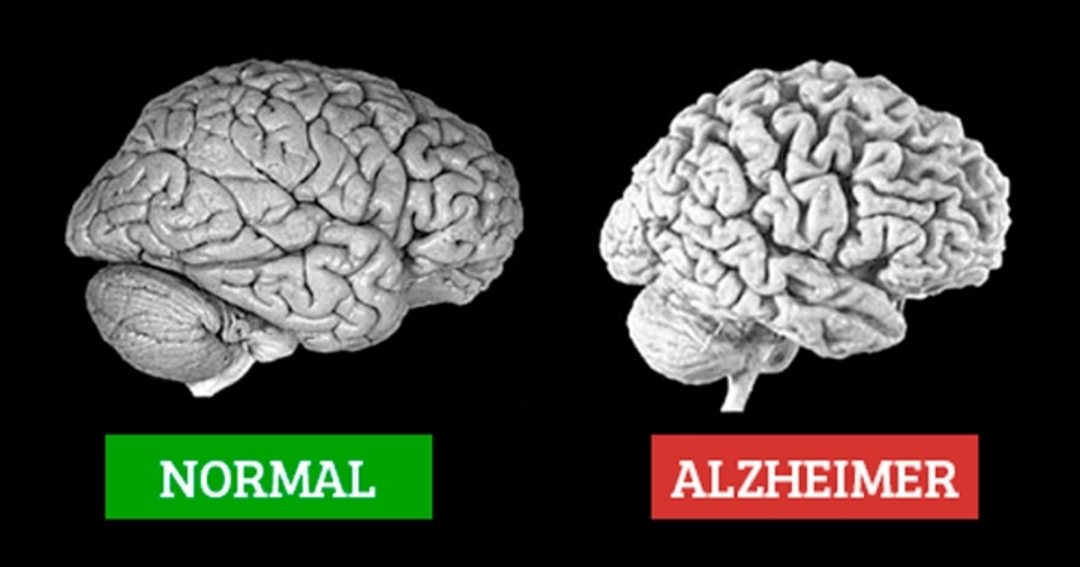 DOENÇA DE ALZHEIMER