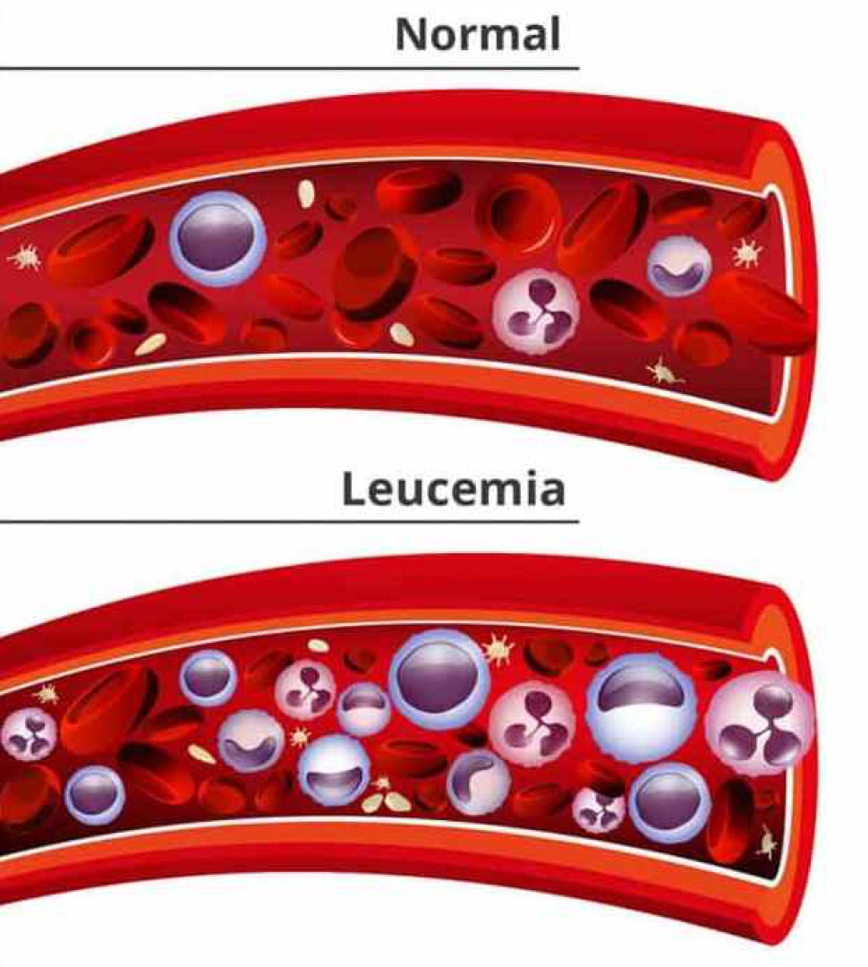 LEUCEMIA